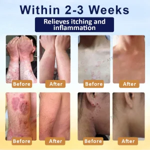 Cvreoz® PsoriasisCare Mellifera Venom Skin Healing Spray