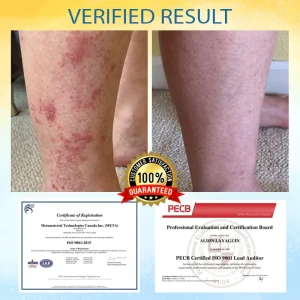 Cvreoz® PsoriasisCare Mellifera Venom Skin Healing Spray