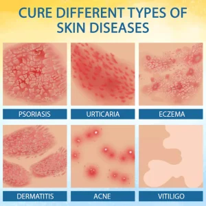 Cvreoz® PsoriasisCare Mellifera Venom Skin Healing Spray