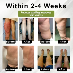 Oveallgo® VeinoRoll Therapy Edema Comfort Cream