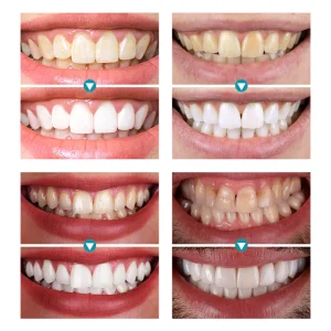 LIMETOW™ Instant Teeth Whitening Paint