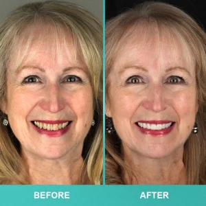 LIMETOW™ Instant Teeth Whitening Paint