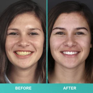 LIMETOW™ Instant Teeth Whitening Paint