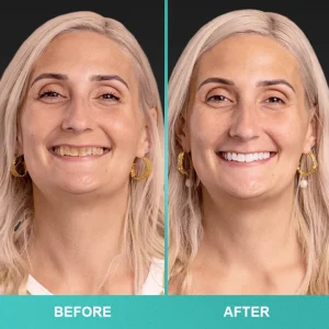 LIMETOW™ Instant Teeth Whitening Paint