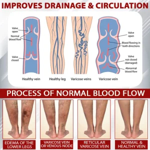 ATTDX® Advanced CVI Edema Therapy Cream 17 ATTDX® Advanced CVI Edema Therapy Cream