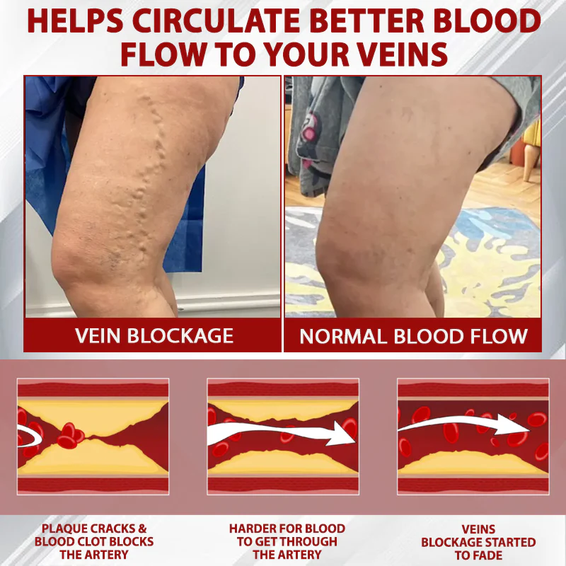 ATTDX® Advanced CVI Edema Therapy Cream 6 ATTDX® Advanced CVI Edema Therapy Cream