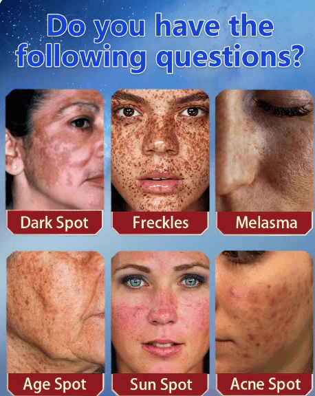 Bikenda™ Blemish Removing Beauty Cream 2 Bikenda™ Blemish Removing Beauty Cream