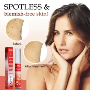 Fivfivgo™ WipeOff Tags & Mole Remover