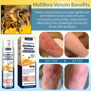 Cvreoz® PsoriasisCare Mellifera Venom Skin Healing Spray